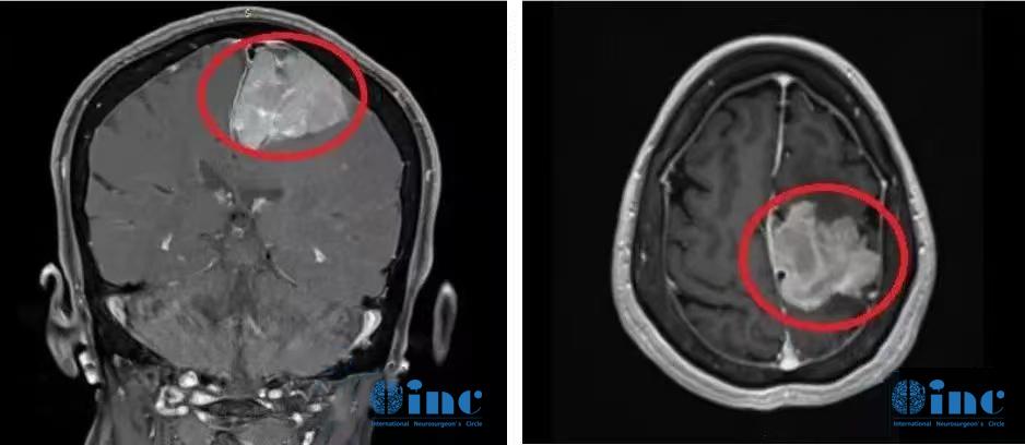 較大腦膜瘤長在大靜脈竇、大腦鐮旁能治愈嗎，復(fù)雜腦膜瘤的治療策略