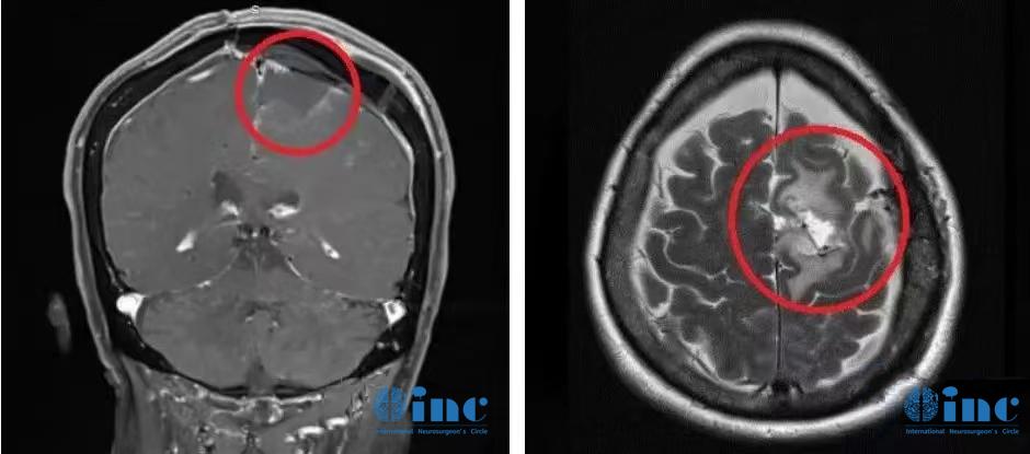 較大腦膜瘤長在大靜脈竇、大腦鐮旁能治愈嗎？復(fù)雜腦膜瘤的治療策略
