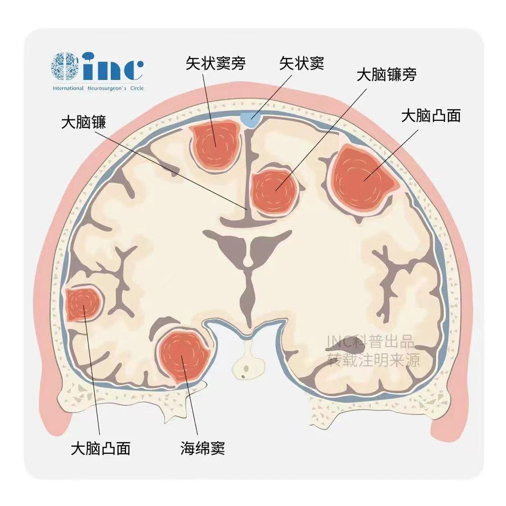　腦膜瘤是一種存在于硬腦膜處緩慢生長的良性腫瘤，由腫瘤性腦膜上皮細(xì)胞所構(gòu)成，惡性檢出率不高。雖然出現(xiàn)惡性腦膜瘤的概率不大，但惡性腦膜瘤的臨床診斷異常困難，誤診率和漏診率較高，導(dǎo)致該病復(fù)發(fā)率、病死率居高不下。手術(shù)治療、放療、化療、觀察隨訪是治療腦膜瘤的主要治療途徑，其中手術(shù)是根治性的一線解決辦法，切除程度往往也決定著治愈率的高低。