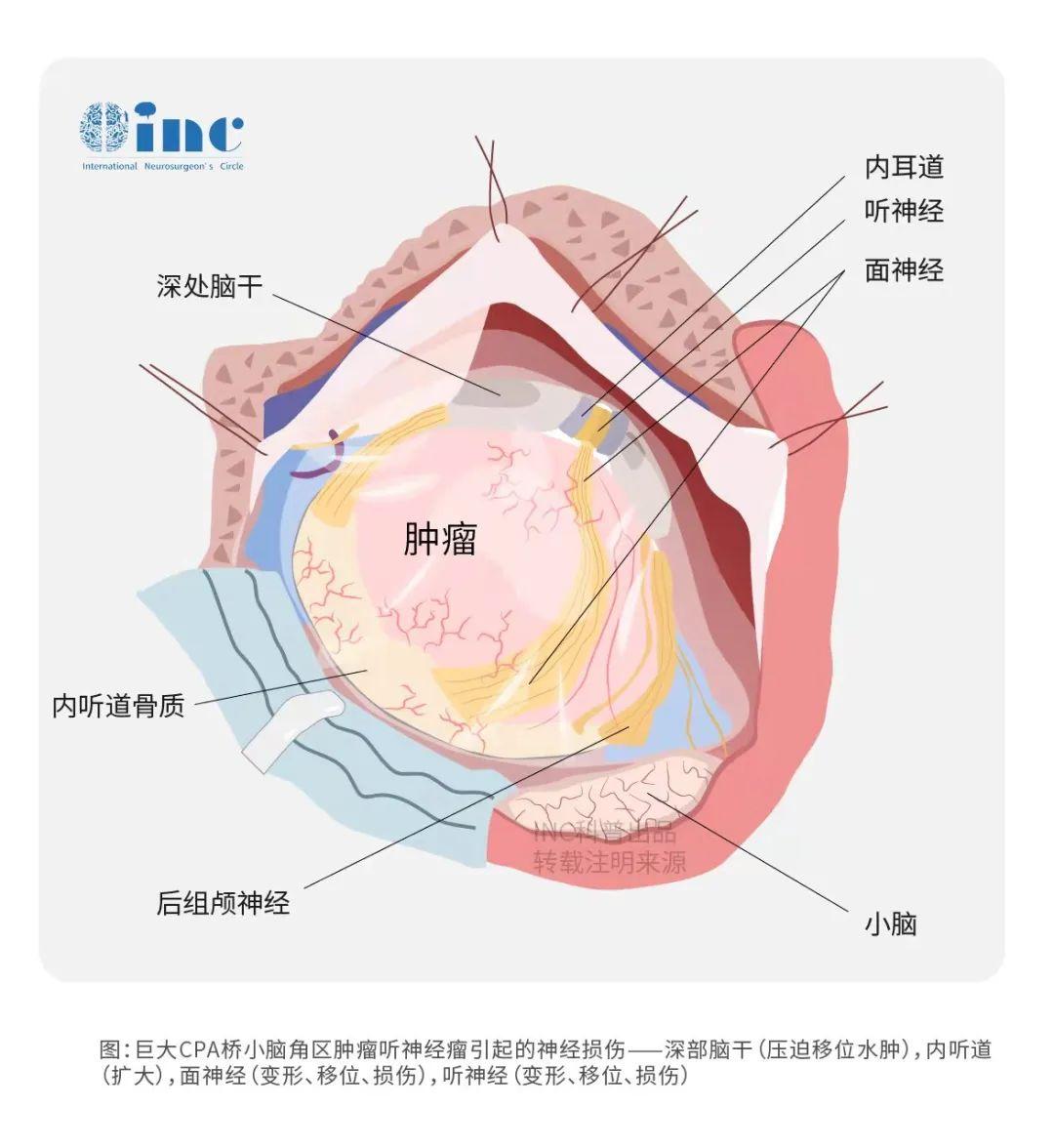 聽(tīng)神經(jīng)瘤復(fù)發(fā)的"七大因素"有哪些？復(fù)發(fā)了應(yīng)該怎么治療？