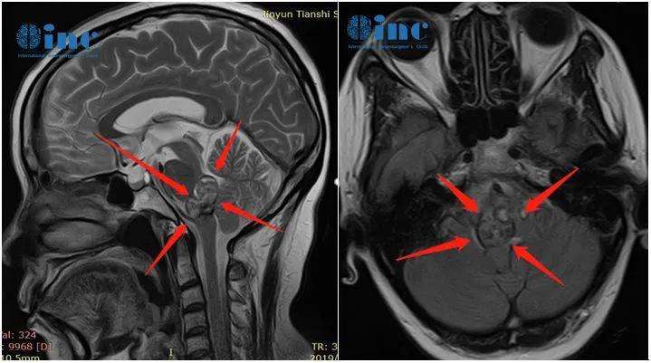 10年6次腦干出血，腦干海綿狀血管瘤手術(shù)后康復(fù)