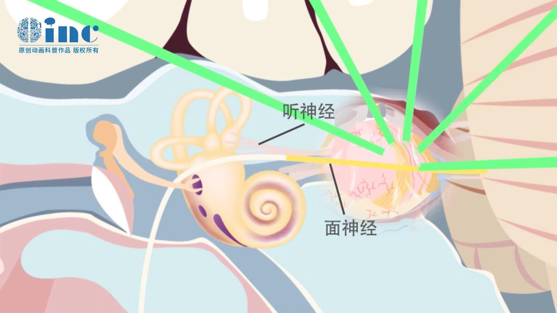 INC德國(guó)<a href='/guojizhuanjia/Bertalanffy.html' target='_blank'><u>巴特朗菲</u></a>教授的前沿手術(shù)理念——聽(tīng)神經(jīng)瘤面癱的九大必知問(wèn)題【術(shù)中篇】