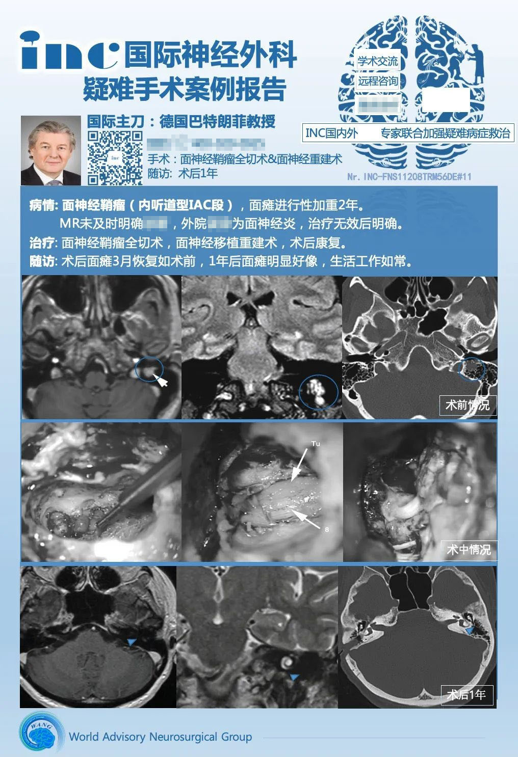 警惕面癱竟是面神經(jīng)鞘瘤作祟，面神經(jīng)鞘瘤誤診、漏診怎么咨詢？