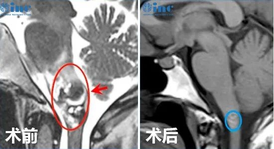 腦干海綿狀血管瘤出血和復(fù)發(fā)因素是什么？