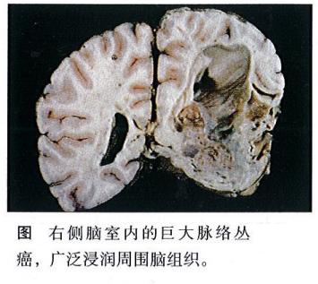 脈絡(luò)叢腫瘤有哪些分型？