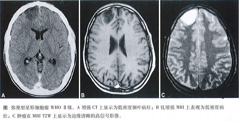 彌漫性低級(jí)別膠質(zhì)瘤生存期
