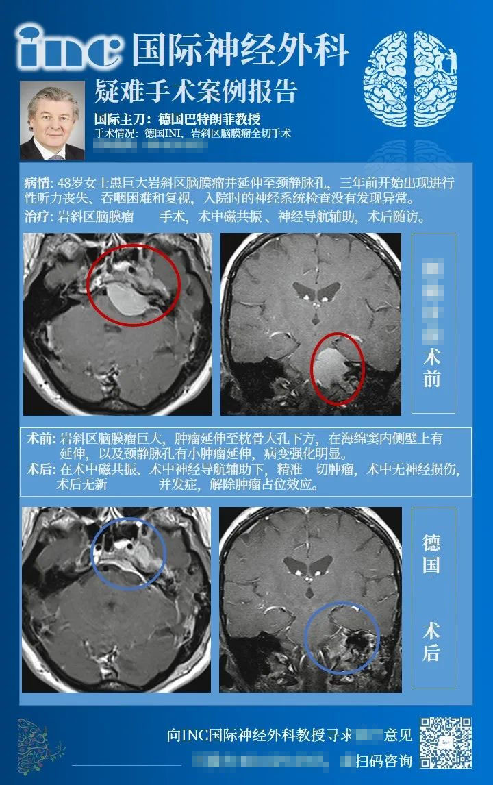 巖斜腦膜瘤手術入路案例