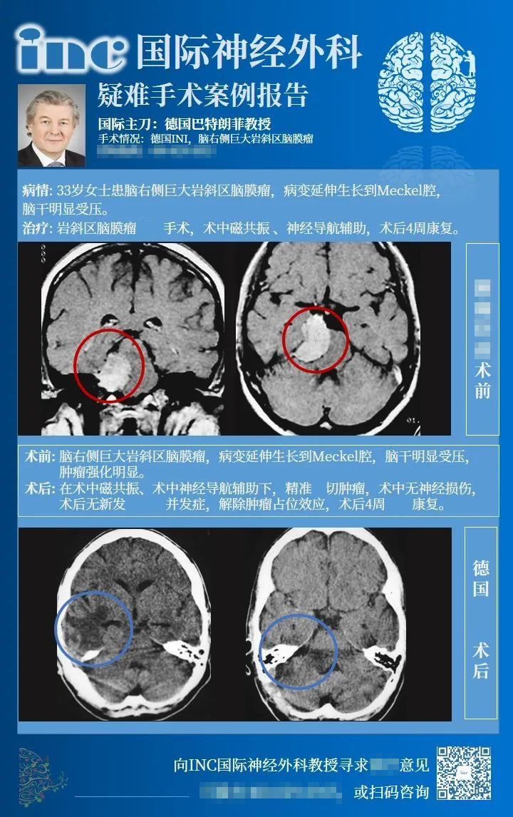 巖斜腦膜瘤手術入路案例1