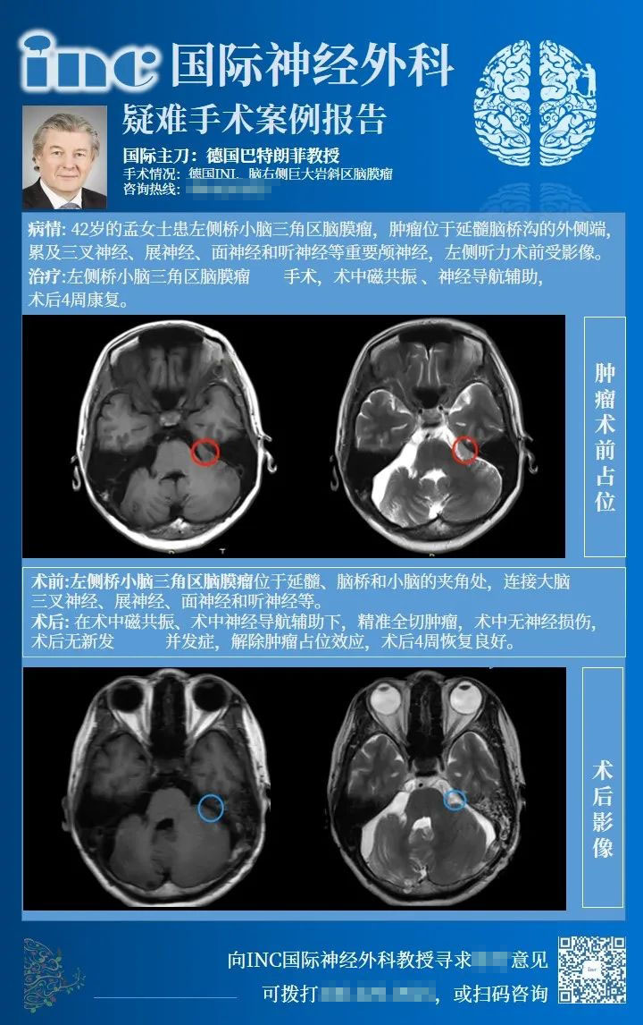 橋小腦角區(qū)腦膜瘤手術(shù)風險大嗎-1