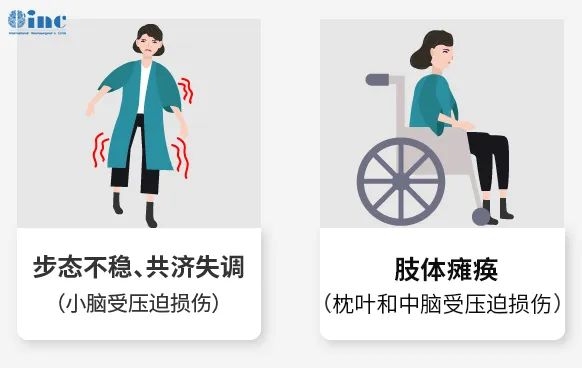 天幕腦膜瘤手術(shù)成功率-1