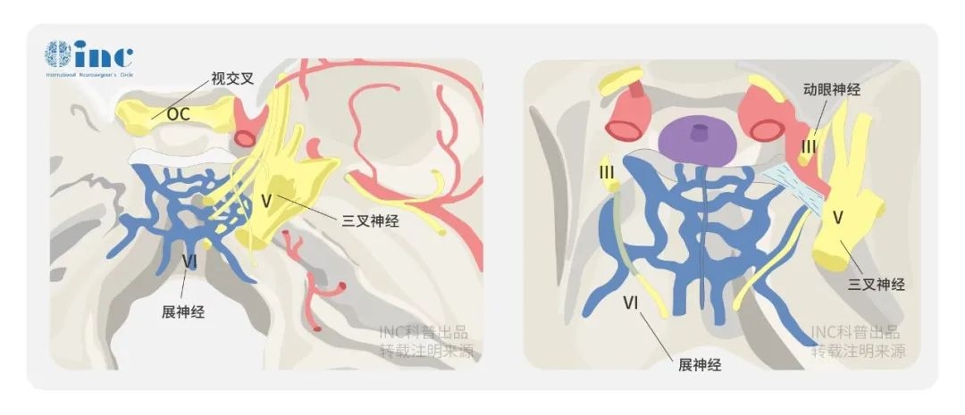 橋小腦角區(qū)腦膜瘤手術難度大嗎？