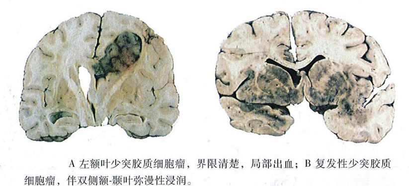 少突膠質(zhì)細(xì)胞瘤的特征表現(xiàn)是什么？