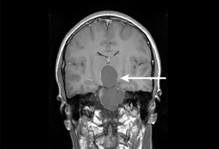 顱咽管瘤是惡性腫瘤嗎？