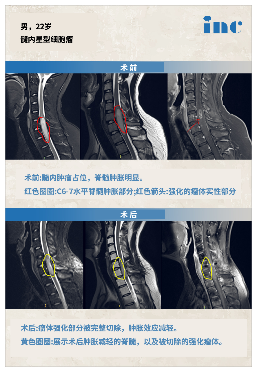 膠質(zhì)瘤案例