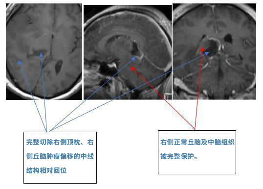 膠質(zhì)母細(xì)胞瘤案例