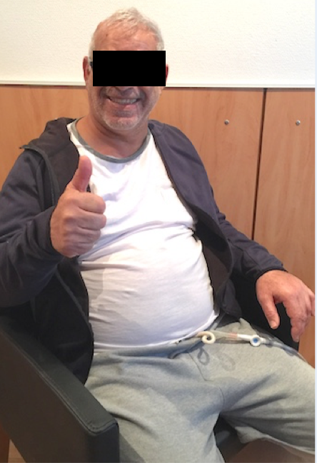 腦干出血，較大腦海綿狀血管瘤如何去除？