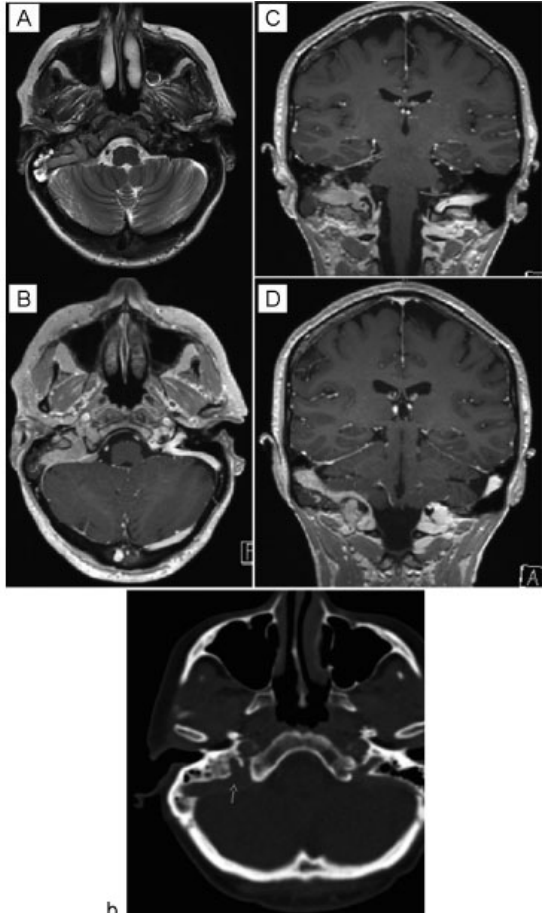 如何治療侵犯橫竇、乙狀竇的頸靜脈孔區(qū)腦膜瘤？
