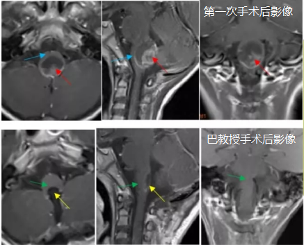 7歲腦干室管膜瘤患兒，手術(shù)全切后恢復(fù)良好