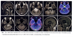 腦干腦橋腫瘤有哪些類(lèi)型和新療法？治療、預(yù)后有何不同？