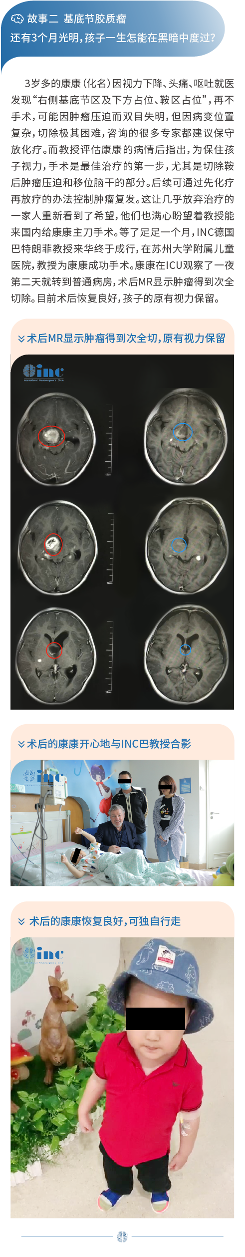 基底節(jié)膠質(zhì)瘤