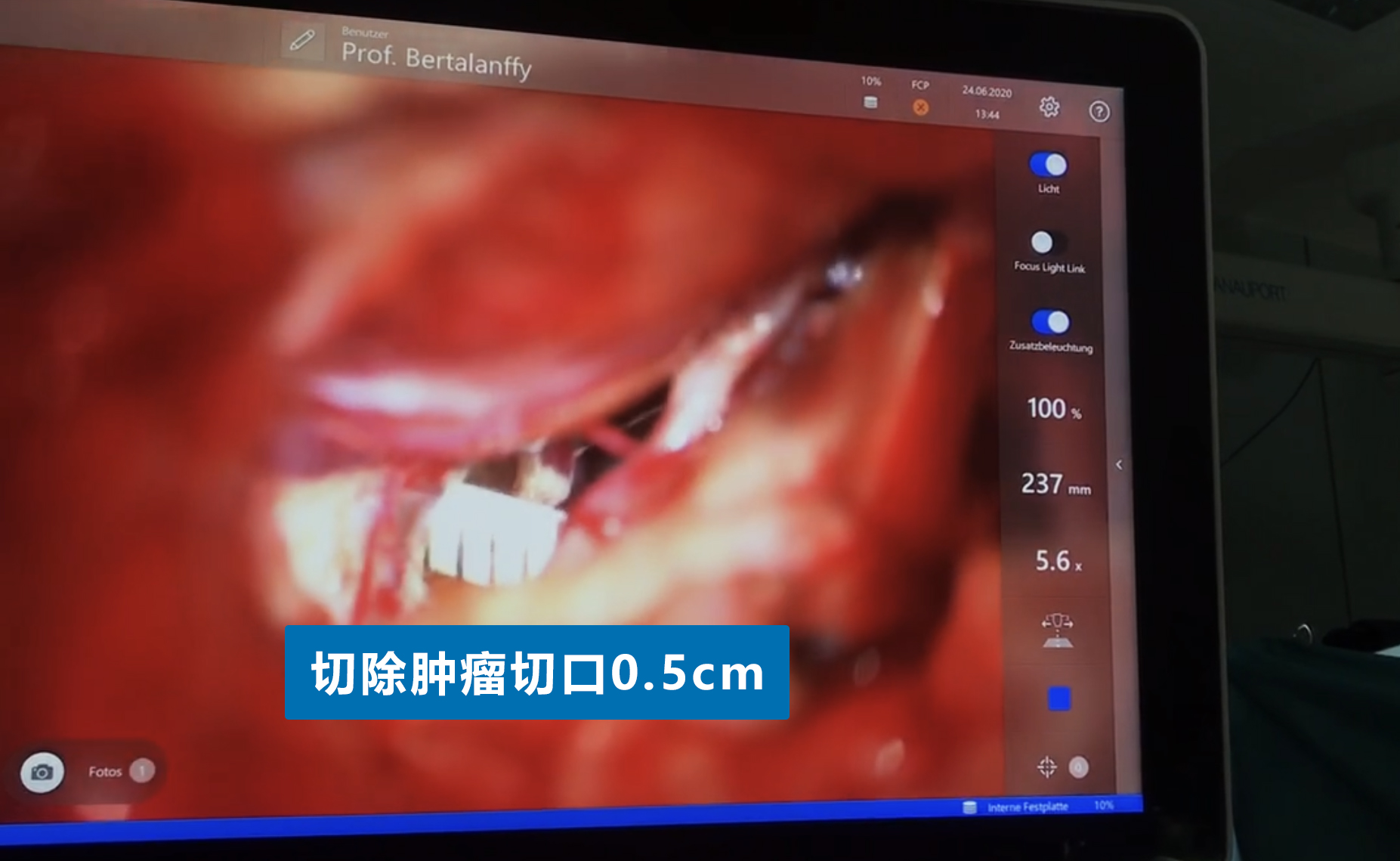 切除<a href='/naoliu/' target='_blank'><u>腦腫瘤</u></a>切口0.5CM
