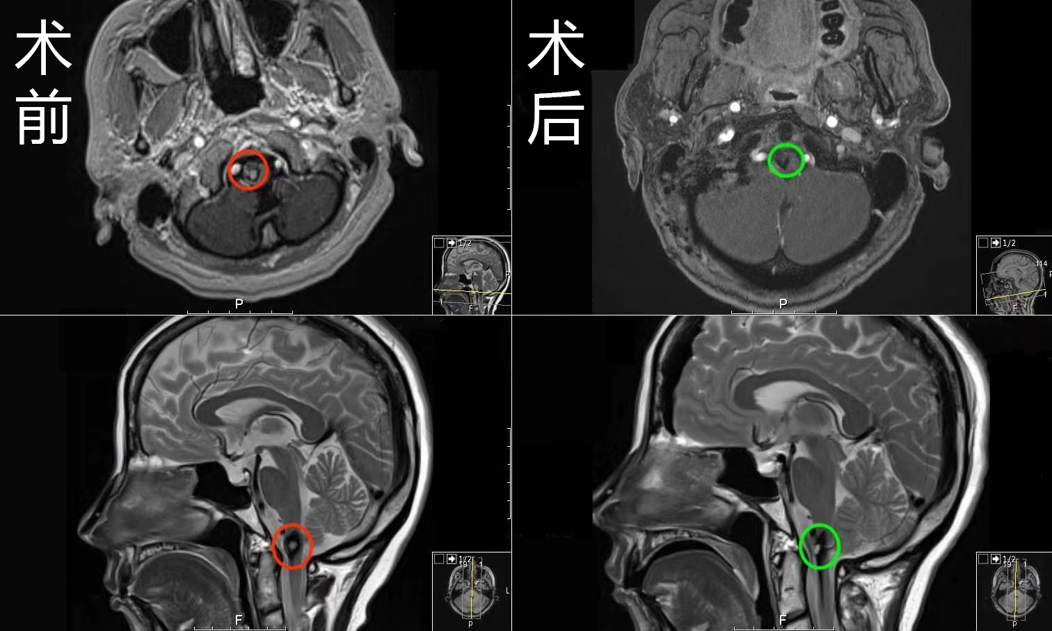 腦干血管病變案例對(duì)比