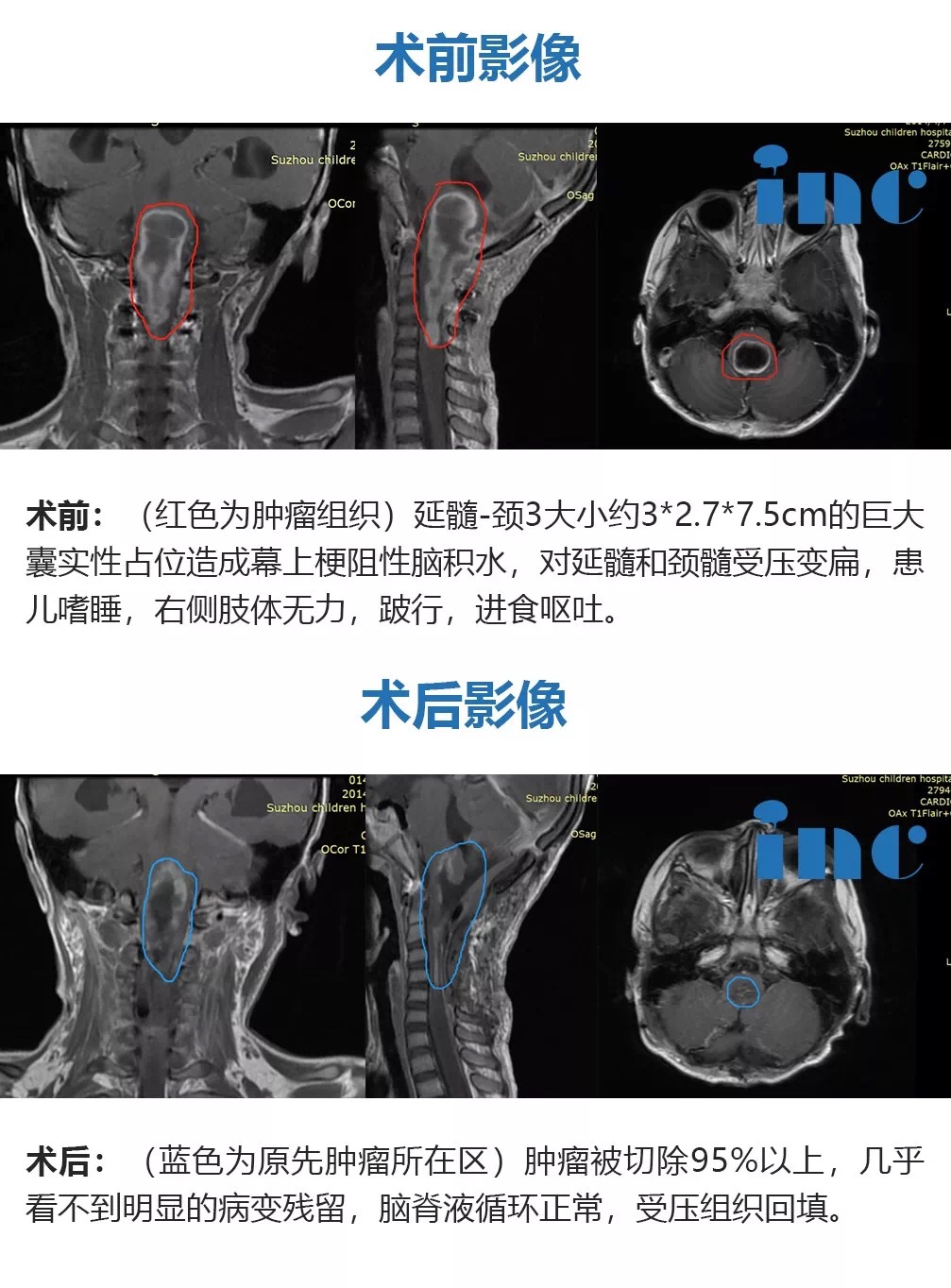 膠質瘤
