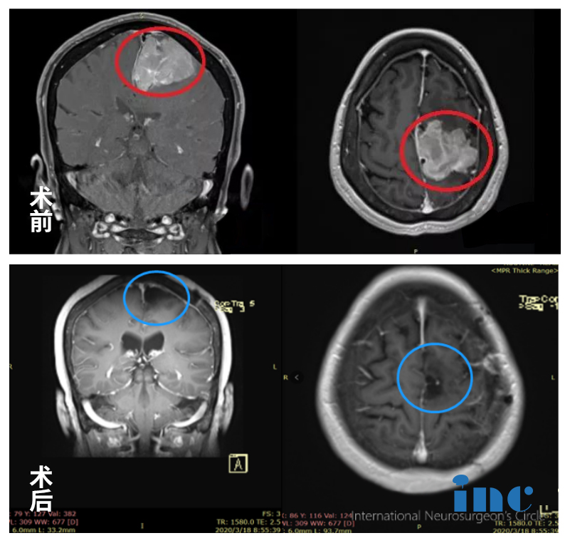 腦膜瘤案例