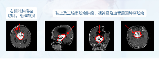 <a href='/jiaozhiliu/' target='_blank'><u>膠質(zhì)瘤</u></a>手術(shù)