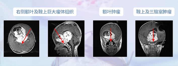 術(shù)前MR