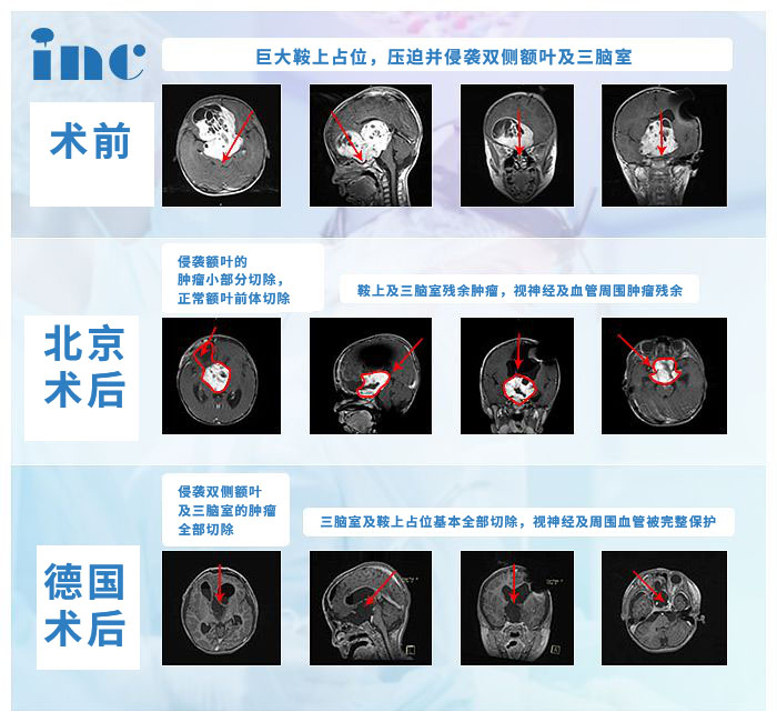 視神經(jīng)膠質(zhì)瘤案例