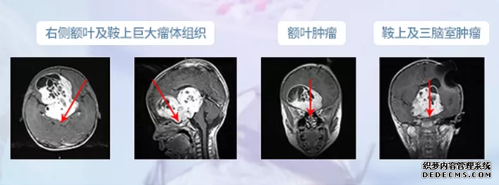 鞍區(qū)腫瘤案例