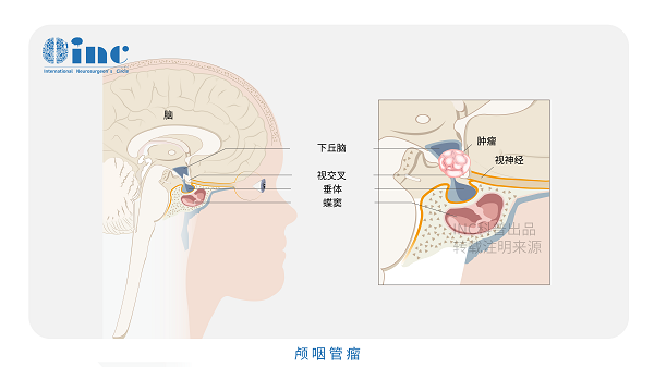 顱咽管瘤術(shù)后能活多久