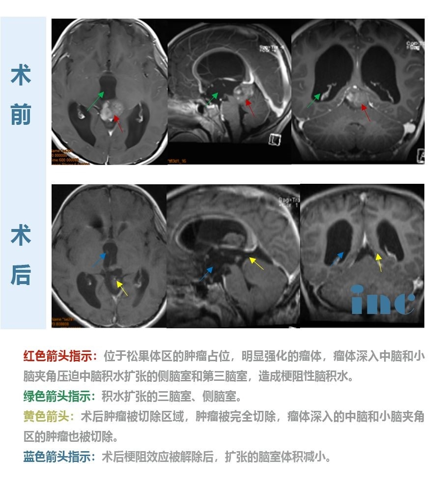 松果體細(xì)胞瘤