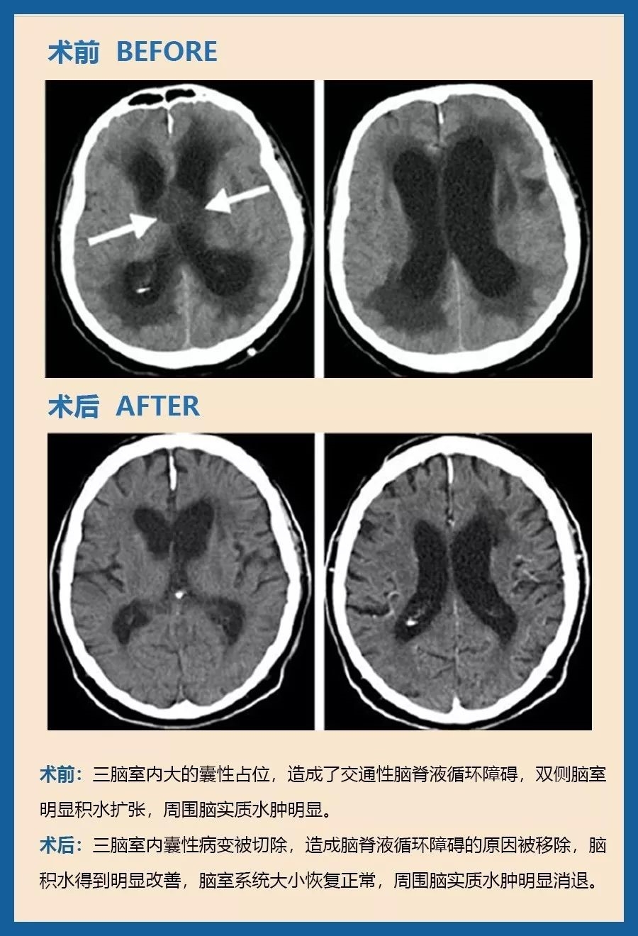 顱咽管瘤有什么危害？