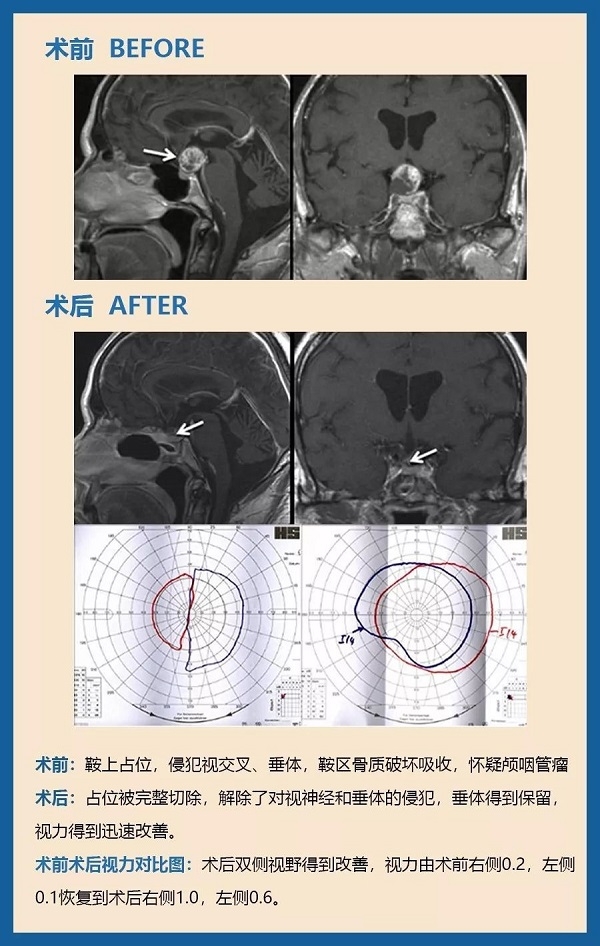 顱咽管瘤有什么危害？案例