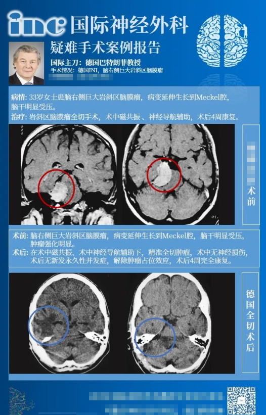 巖斜區(qū)腦膜瘤手術(shù)風(fēng)險(xiǎn)