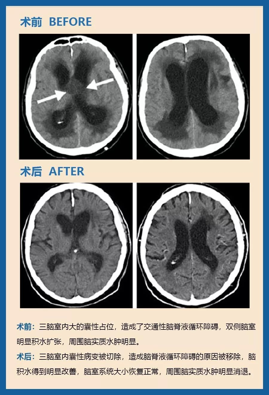 顱咽管瘤可以微創(chuàng)手術(shù)嗎？