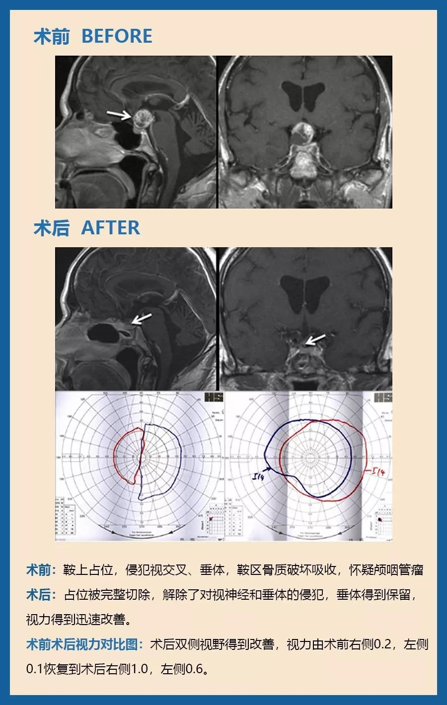 顱咽管瘤可以微創(chuàng)手術(shù)嗎？圖片