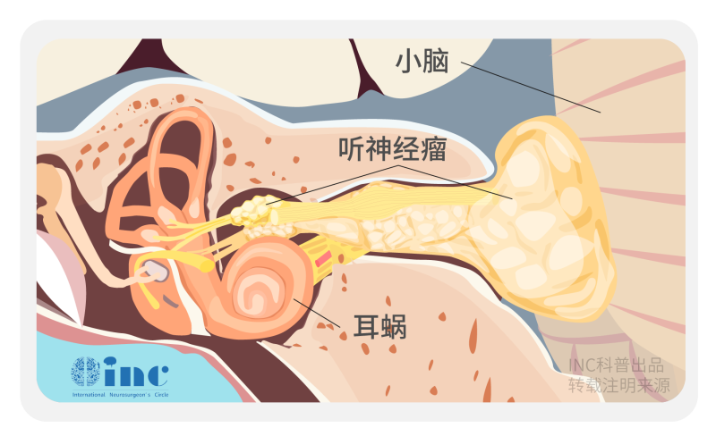 聽神經(jīng)瘤手術(shù)好還是放療好？