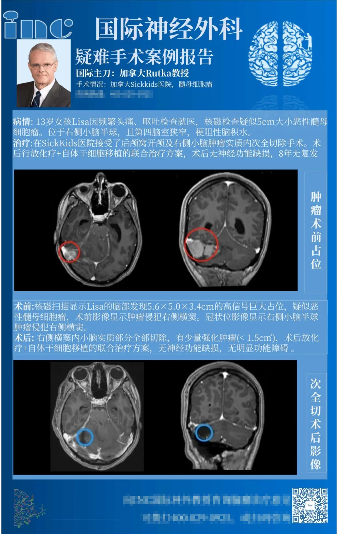 5cm較大髓母細胞瘤能活多久？
