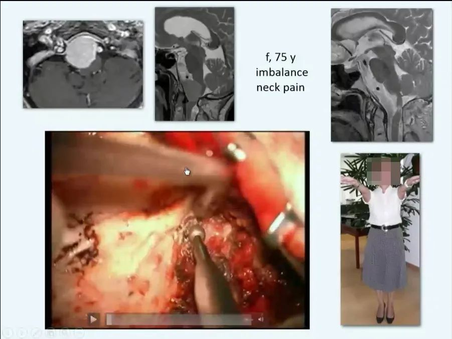 枕骨大孔區(qū)腦膜瘤治療