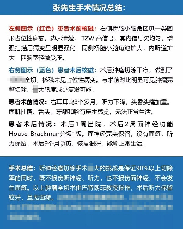 聽神經(jīng)瘤治療