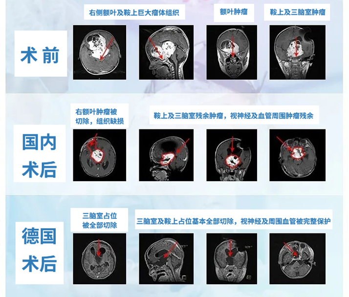 兒童視神經(jīng)膠質(zhì)瘤能治好嗎？案例