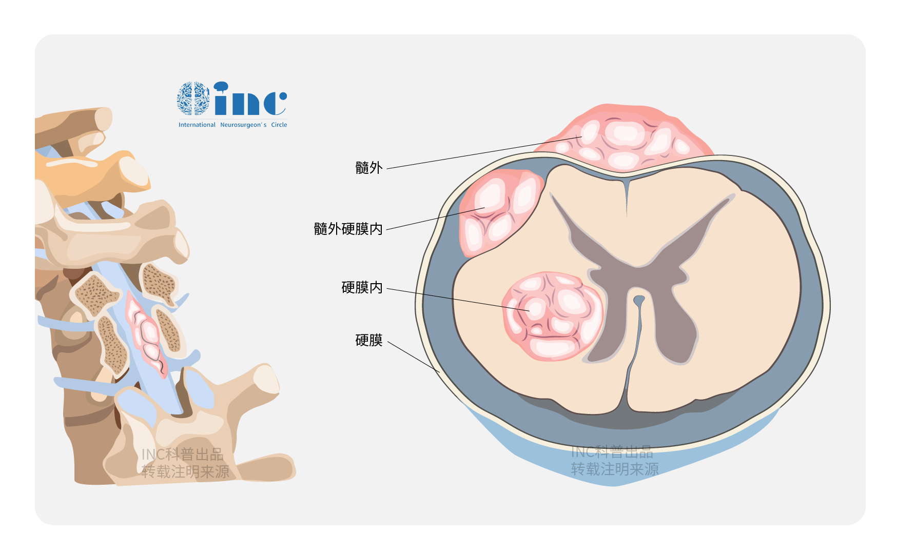 脊髓髓內(nèi)海綿狀血管瘤