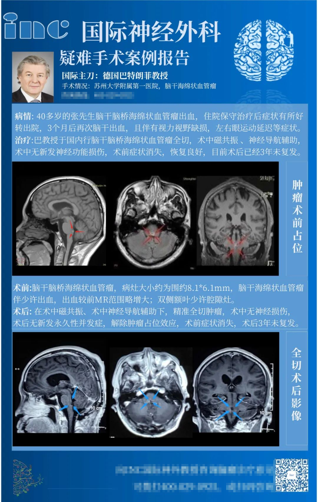 腦干橋腦海綿狀血管瘤