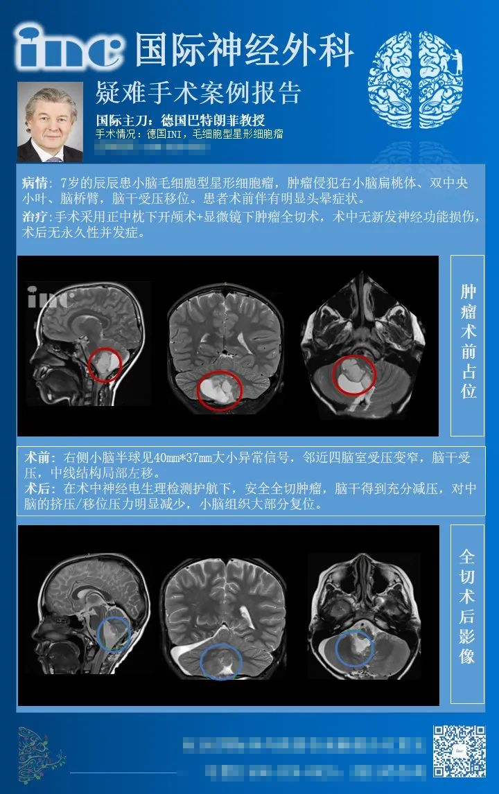毛細(xì)胞型星形細(xì)胞瘤