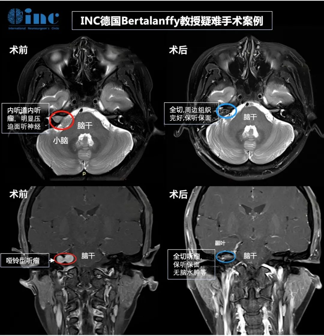 聽(tīng)神經(jīng)瘤案例