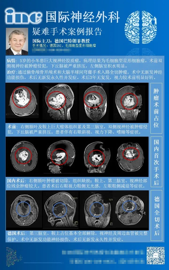 視神經(jīng)膠質(zhì)瘤手術(shù)