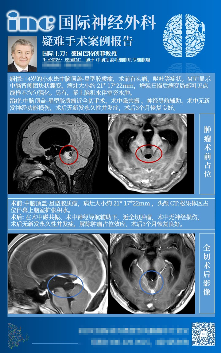 星形細(xì)胞瘤治療方法-2